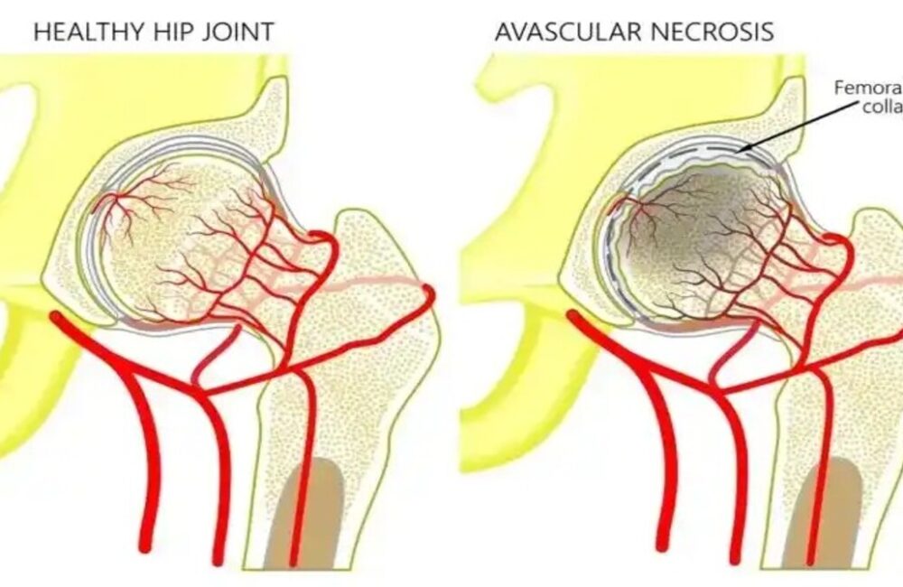 Surge in Avascular Necrosis Cases Linked to Covid Treatment