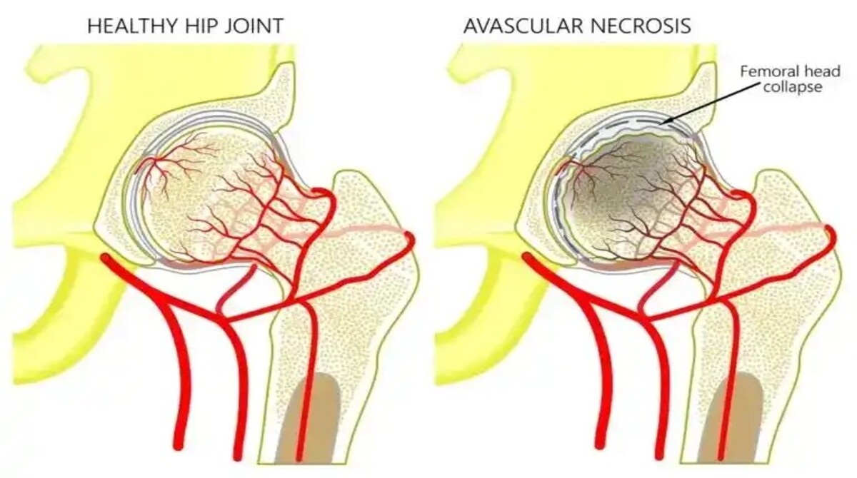 Surge in Avascular Necrosis Cases Linked to Covid Treatment