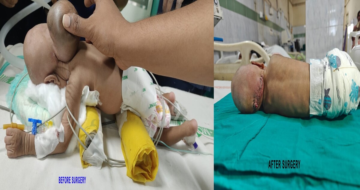 Rare brain surgery on newborn performed successfully at KGH