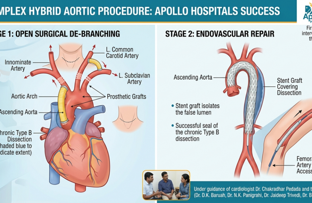 Vizag Doctors Perform First Hybrid Surgery for Aortic Dissection
