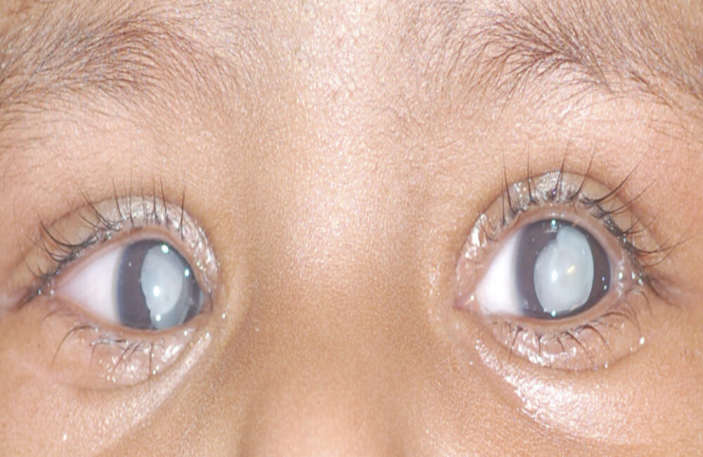 Doctors caution parents against vision-threatening ROP in premature babies