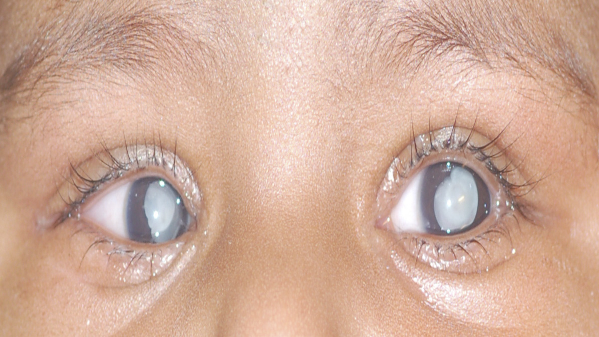 Doctors caution parents against vision-threatening ROP in premature babies